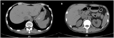 Acute pulmonary embolism following corticosteroid administration in acute severe ulcerative colitis with gastrointestinal bleeding: A case report